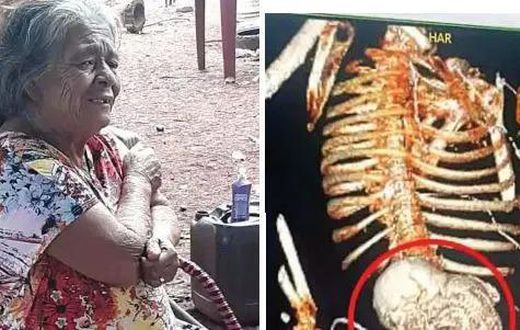 Woman carries dead foetus for 56 years, dies after removal surgery