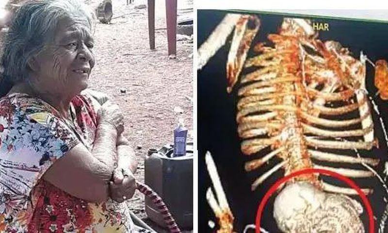 Woman carries dead foetus for 56 years, dies after removal surgery