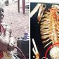 Woman carries dead foetus for 56 years, dies after removal surgery