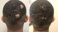 How to regrow bald spots [eternaldermatology]