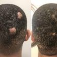 How to regrow bald spots [eternaldermatology]