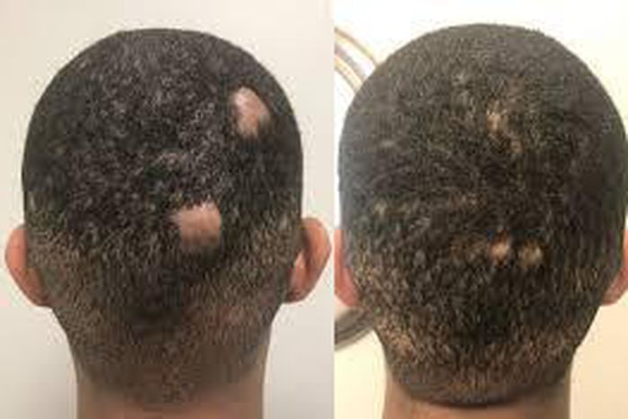 How to regrow bald spots [eternaldermatology]