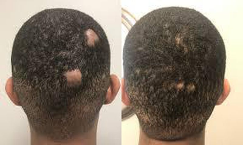 How to regrow bald spots [eternaldermatology]