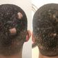 How to regrow bald spots [eternaldermatology]