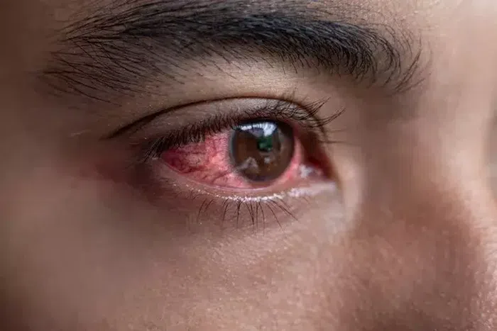 Sudden red eye in the morning could be a sign of conjunctivitis [Depositphotos]