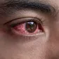 Sudden red eye in the morning could be a sign of conjunctivitis [Depositphotos]