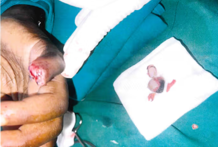 Molly Katanga suffered severe injuries