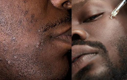 How to prevent ingrown hairs from messing up your skin