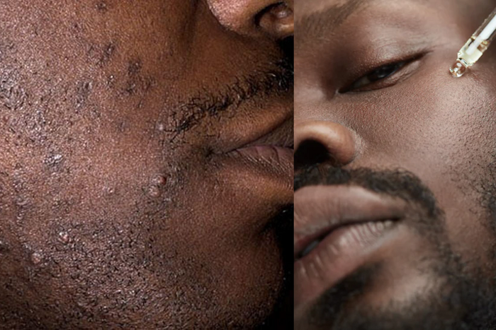 How to prevent ingrown hairs from messing up your skin