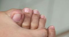 Unable to separate little toe