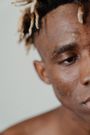 Triangle of death: Don't pop pimples in this body region/Pexels