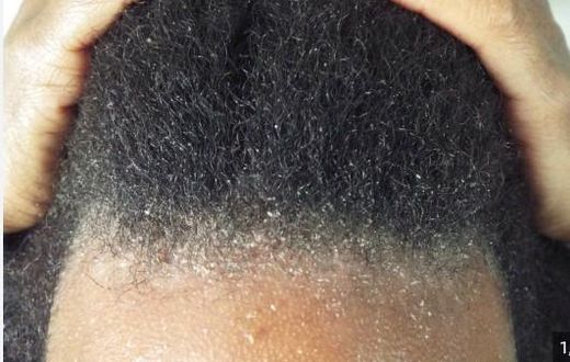 Dandruff