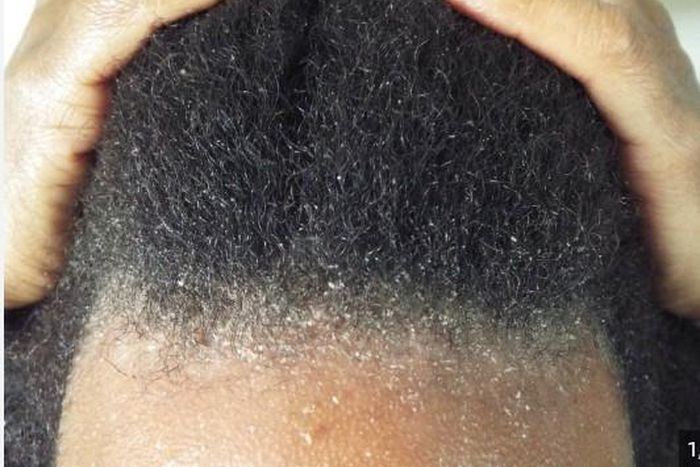 Dandruff