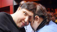 Conjoined twins Lori and George Schapell