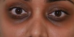 Dark under eye circles