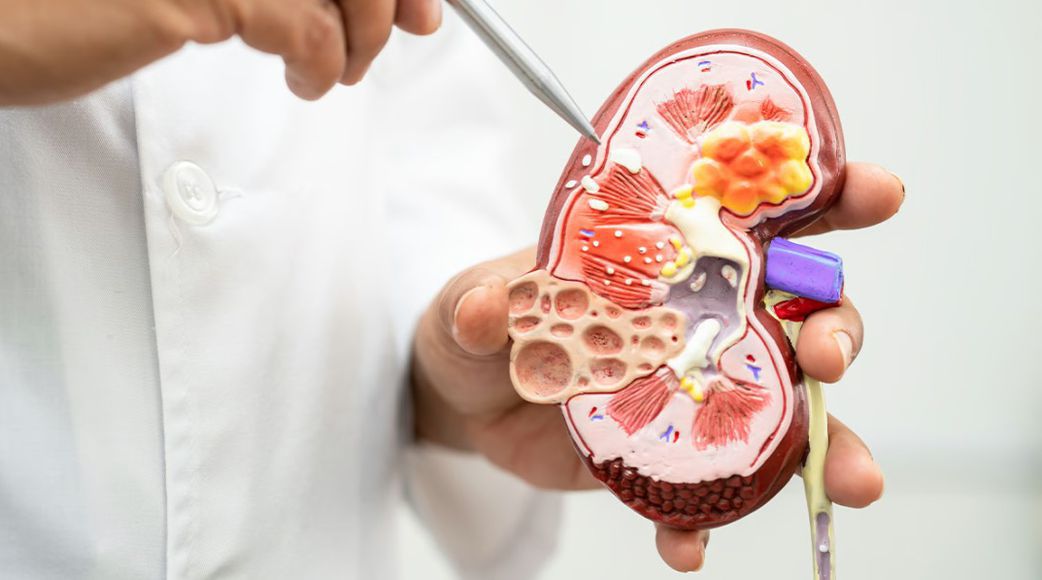 Kenyans who sold their kidneys: Amount received, regrets & challenges