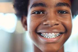 Teeth braces side effects: What you should know before getting them