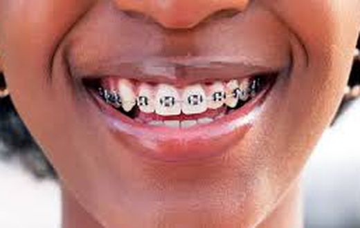 A person with braces