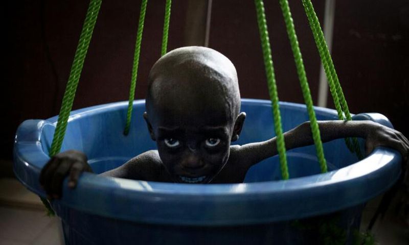 A malnourished girl being weighed, a daily for children who are hospitalised for a little over a week until their weight recovers