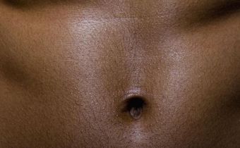 Dr. Pimple Popper Pops a 'Belly Button' Blackhead