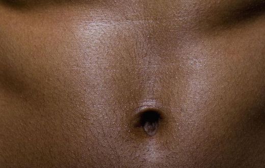 Dr. Pimple Popper Pops a 'Belly Button' Blackhead