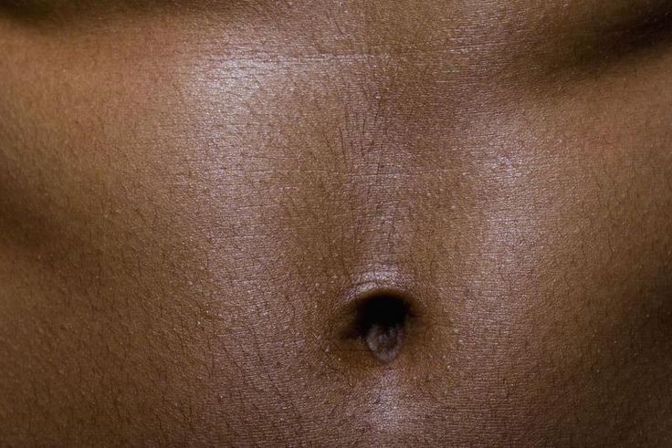 Dr. Pimple Popper Pops a 'Belly Button' Blackhead