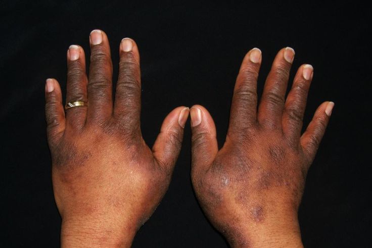 ___9152831___2018___11___30___8___Atopic-dermatitis-in-a-pizza-shop-worker.image-from-Matt-Zirwas