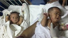 Tofa and Tahura, ten-month-old twins who were born conjoined at the spine and rectum, were separated by a team of two dozen doctors Tuesday in Dhaka