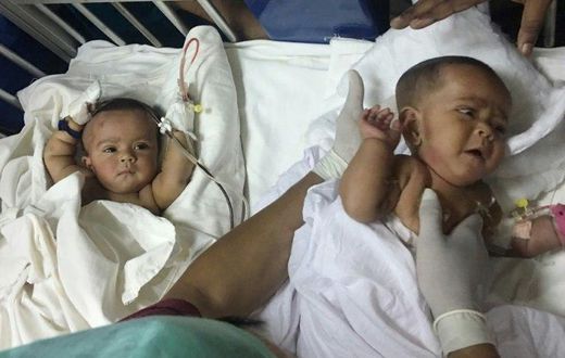 Tofa and Tahura, ten-month-old twins who were born conjoined at the spine and rectum, were separated by a team of two dozen doctors Tuesday in Dhaka