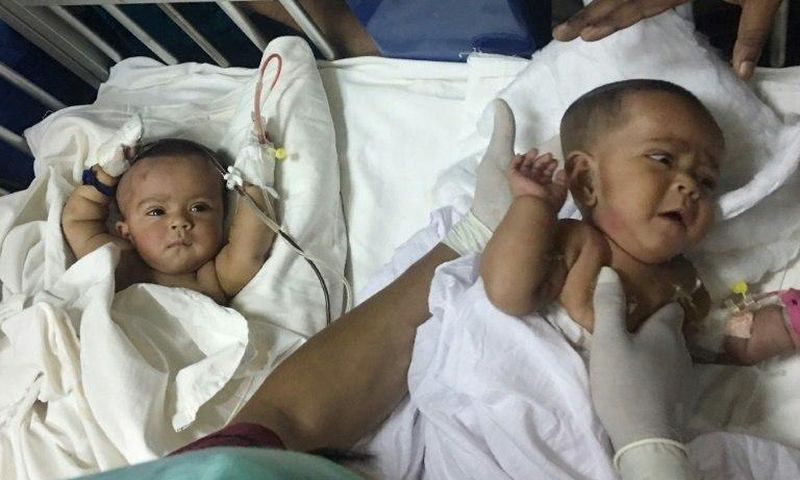 Tofa and Tahura, ten-month-old twins who were born conjoined at the spine and rectum, were separated by a team of two dozen doctors Tuesday in Dhaka