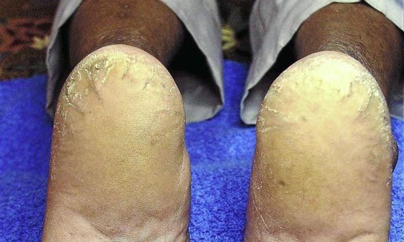Cracked feet (Star)