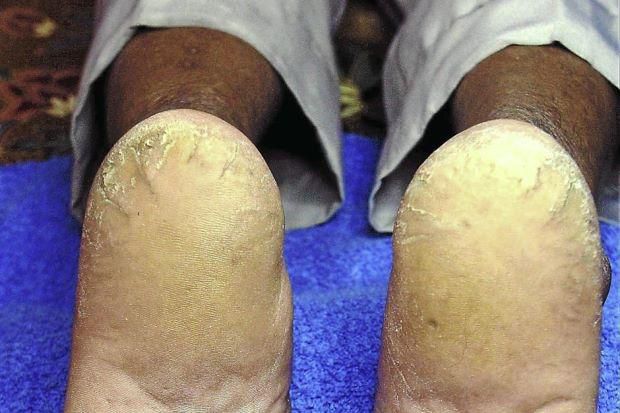 Cracked feet (Star)