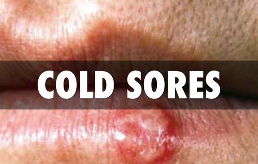 Nipple cream works!
