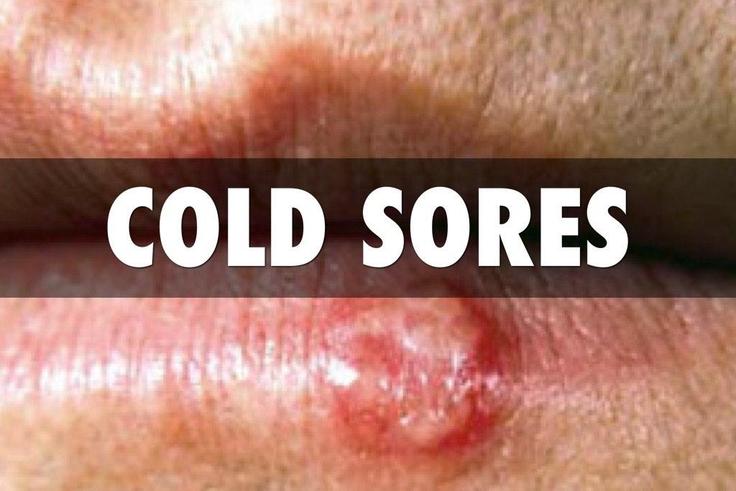 Nipple cream works!