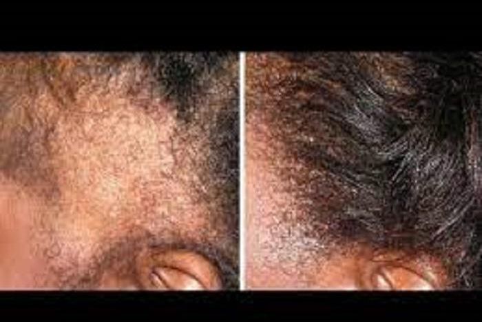 4 simple ways to grow the edges of your hair back