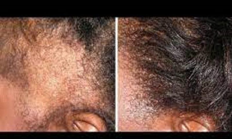 4 simple ways to grow the edges of your hair back