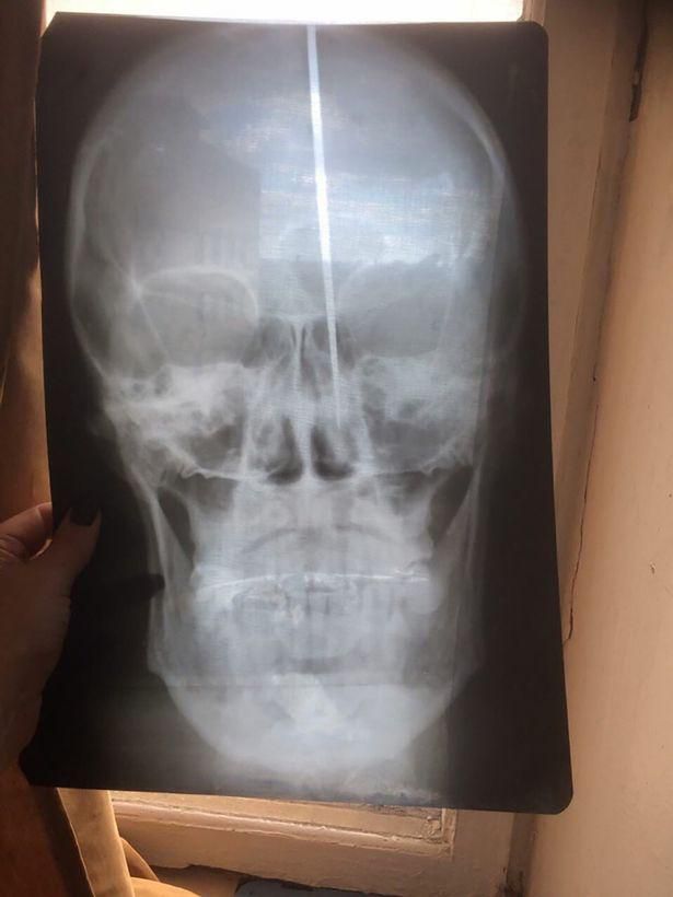 Man plunges knife into his own skull so he can 'breathe better' (Photos)