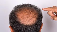 ___9072040___2018___11___5___14___balding