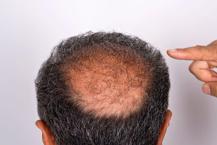 ___9072040___2018___11___5___14___balding