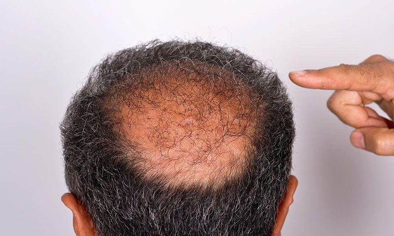 ___9072040___2018___11___5___14___balding