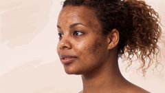 Woman with acne(Well+Good)