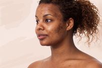 Woman with acne(Well+Good)