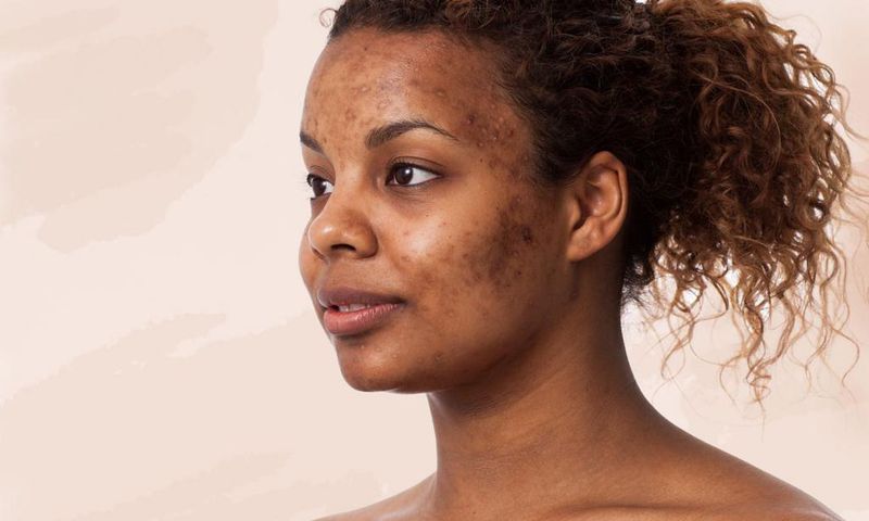 Woman with acne(Well+Good)