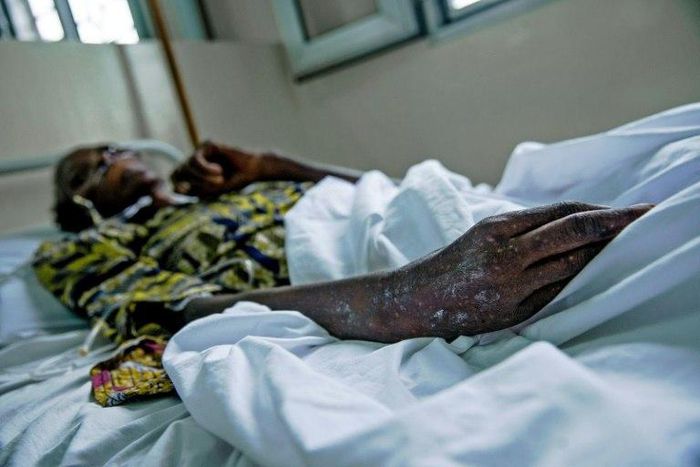 AIDS claimed a million lives in 2016, almost half the 2005 toll that marked the peak of the deadly epidemic, said a UN report