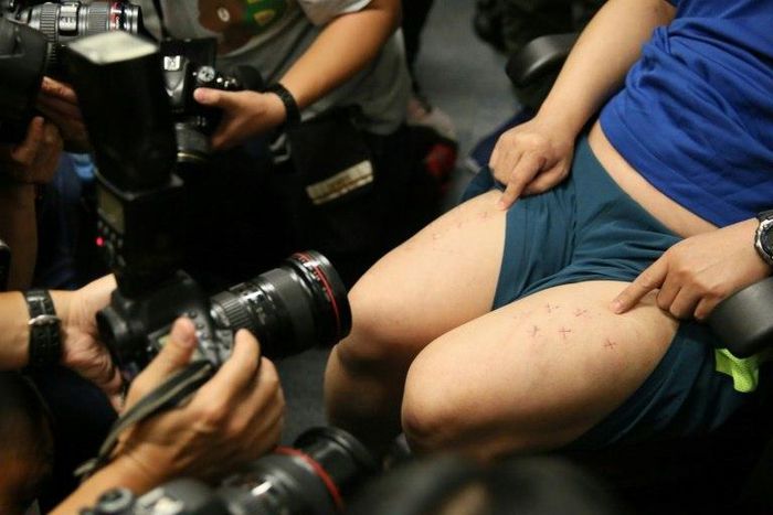 Howard Lam said he had been kidnapped from a busy Hong Kong street in broad daylight by mainland Chinese agents who punctured his legs with staples