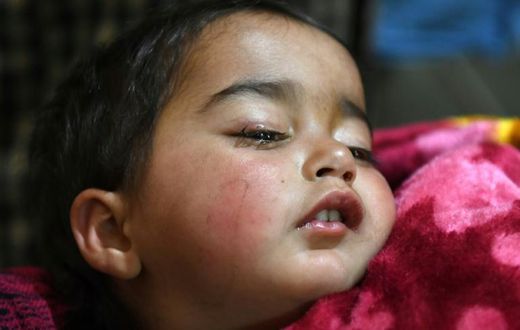 Hiba Jan was hit by a pellet fired from a pump-action gun in Kashmir