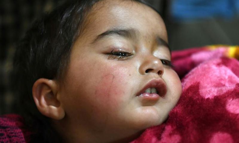 Hiba Jan was hit by a pellet fired from a pump-action gun in Kashmir