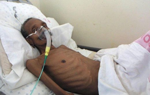 About one in five TB cases are resistant to at least one antibiotic, and about five percent are so-called multidrug resistant (MDR-TB) strains
