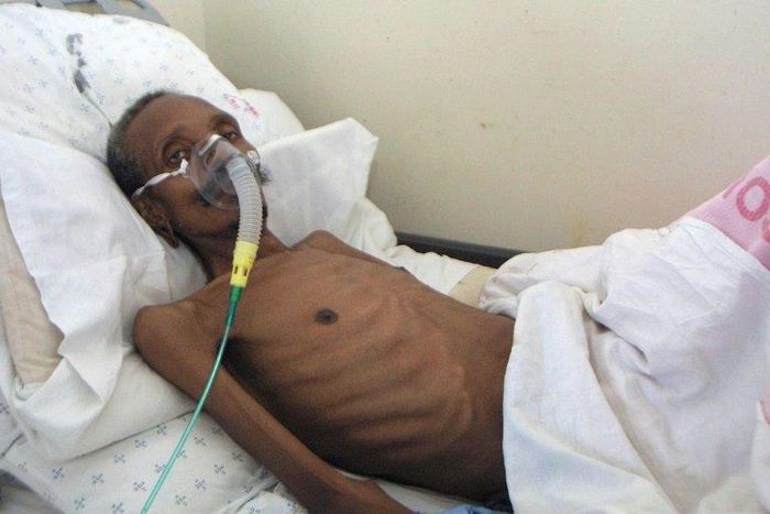 About one in five TB cases are resistant to at least one antibiotic, and about five percent are so-called multidrug resistant (MDR-TB) strains