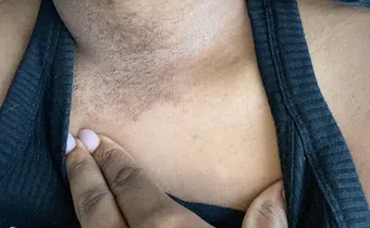 Jewellery rash